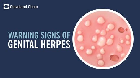 herpes on testicles pictures|hsv 1 symptoms in males.